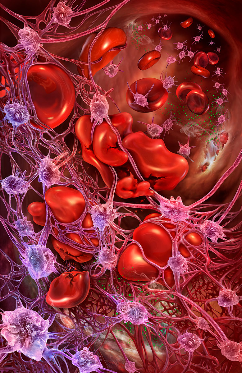 Atypical Hemolytic Uremic Syndrome (aHUS) © Cynthia Turner Atypical Hemolytic Uremic Syndrome (aHUS) © Cynthia Turner